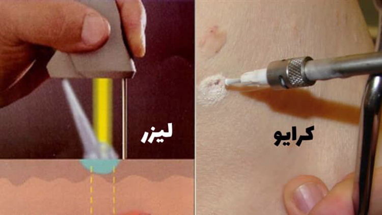 درمان زگیل تناسلی با لیزر یا کرایو1