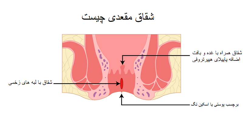 ​شقاق چیست​