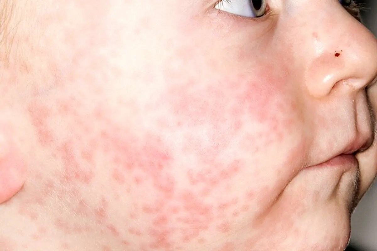 ابتلای ۱۰۰۰ نفر به سرخک در ایران!