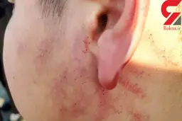 ضرب‌وشتم دانش‌آموز ابتدایی / این‌بار در نوشهر +عکس دردناک