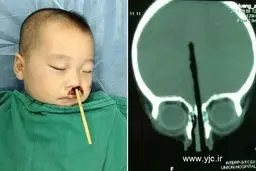 خارج کردن چوب غذا از سر کودک چینی +عکس