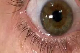 کدام تغییرات در چشم نشانه ابتلا به کروناست؟