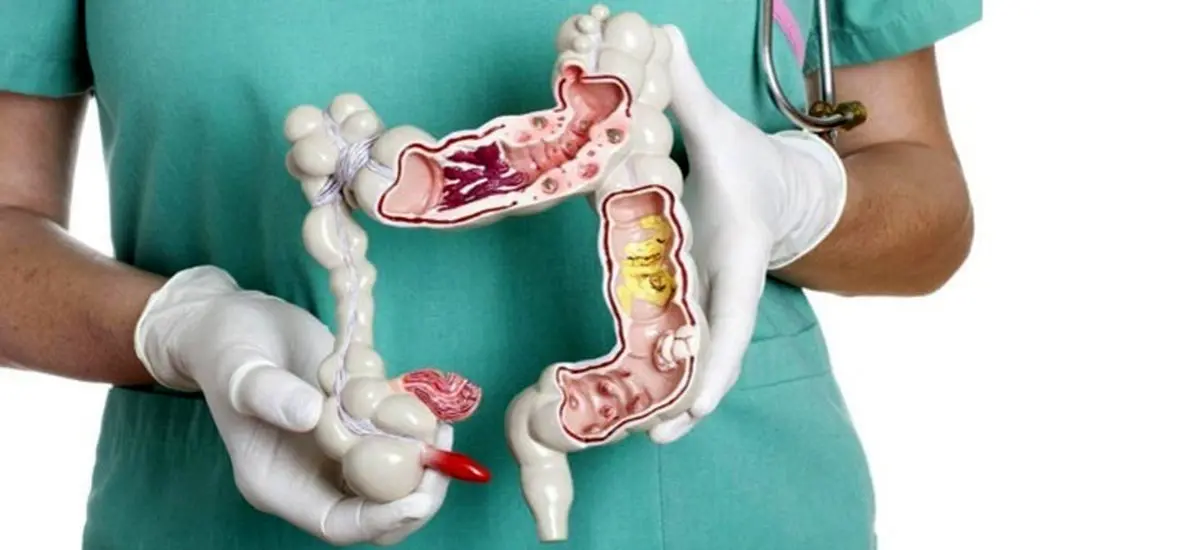 ۵ خوردنی معجزه آسا برای پیشگیری از سرطان روده بزرگ