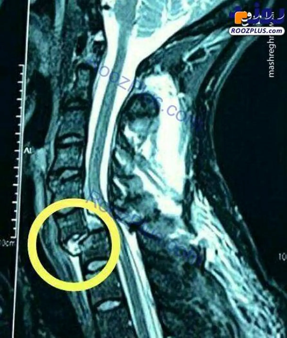 تصویری هولناک از شکستگی گردن بازیکن استقلال!