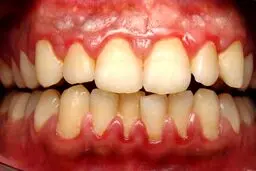 رابطه سلامت دهان با سرطان‌های ریه و گوارش