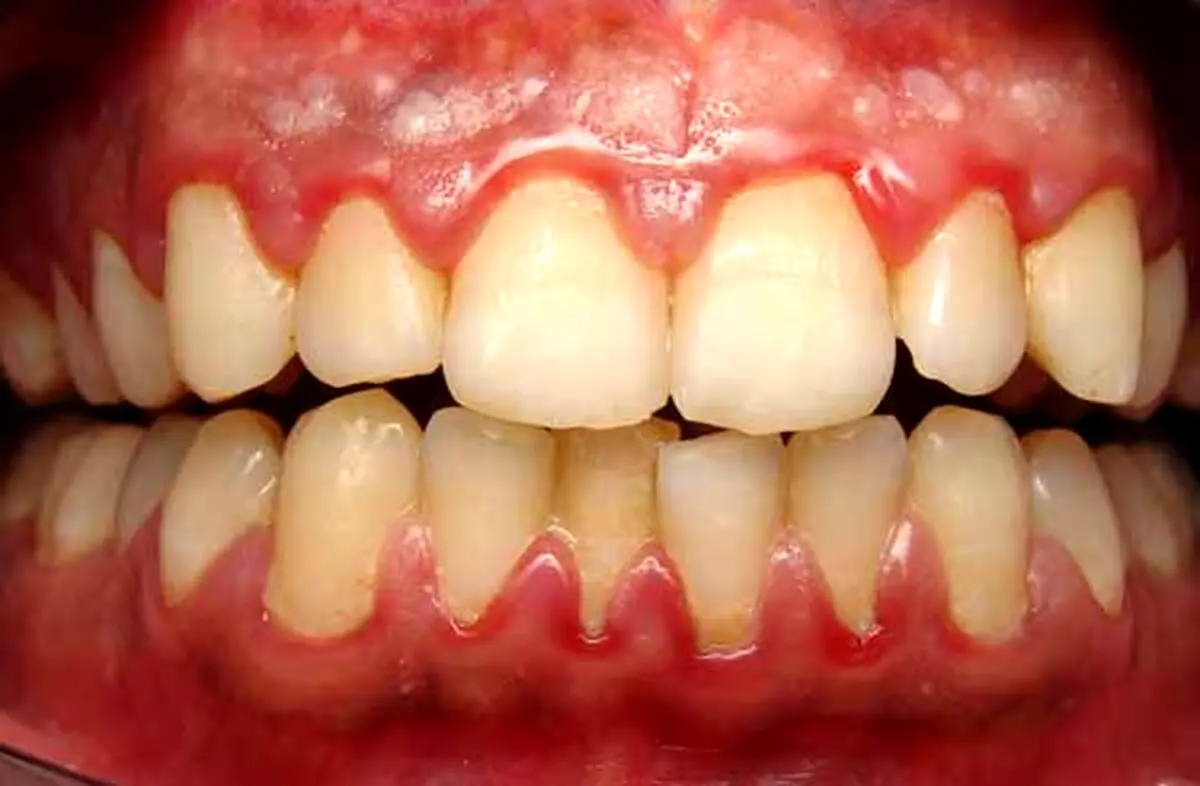 رابطه سلامت دهان با سرطان‌های ریه و گوارش