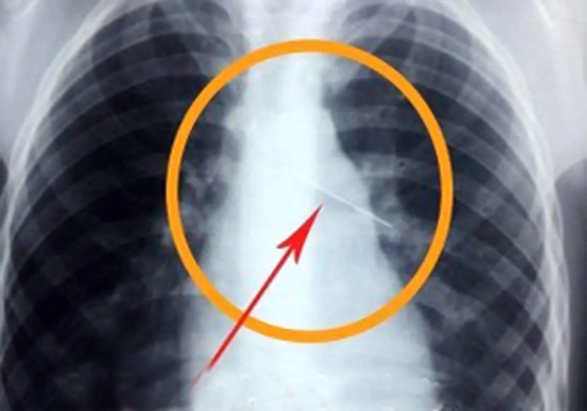 دختر اهوازی سر کلاس سوزن قورت داد /خانواده وی به مدرسه حمله کردند ! + عکس