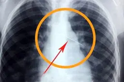 دختر اهوازی سر کلاس سوزن قورت داد /خانواده وی به مدرسه حمله کردند ! + عکس