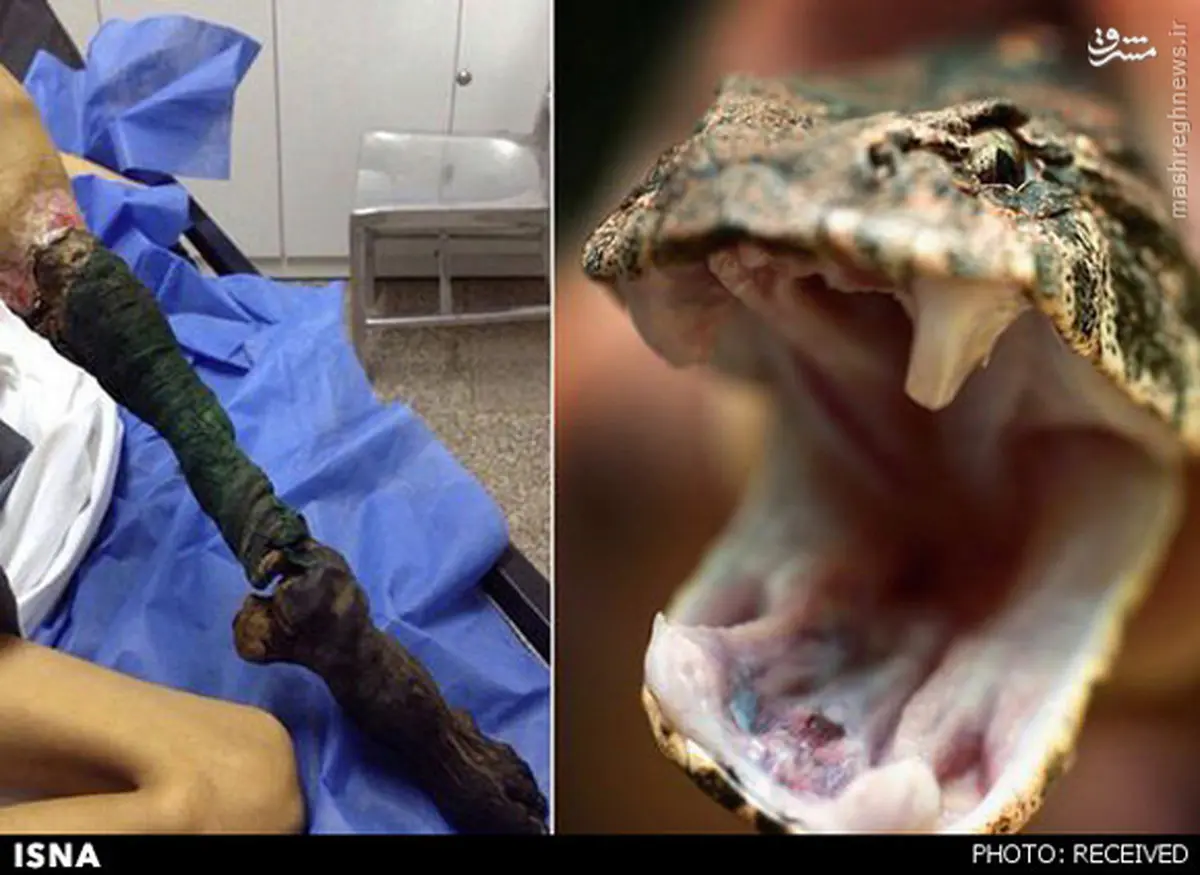 عکس مارگزیدگی عجیب در ونزوئلا