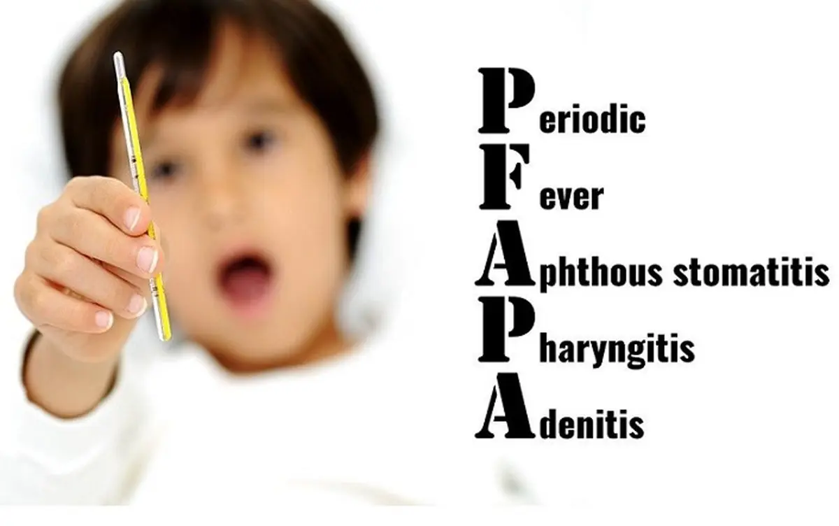 علت و درمان تب دوره ای کودکان همراه با آفت دهان