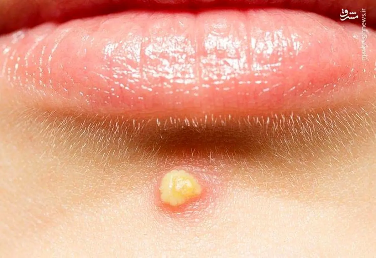 انواع آکنه‌های پوستی و راه درمان آن را بشناسید + عکس