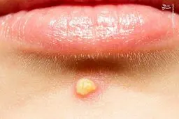 انواع آکنه‌های پوستی و راه درمان آن را بشناسید + عکس