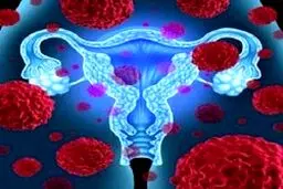 تاثیر قرص های ضدبارداری در مقابله با سرطان تخمدان