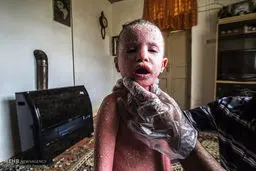 روایتی دردناک از بیماری پوستی نرگس کوچولو /گزارش تصویری