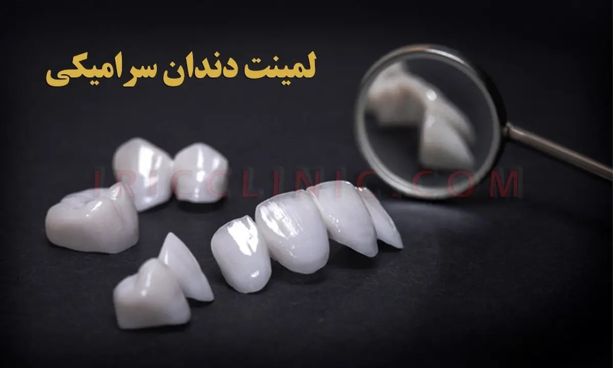 قیمت لمینت سرامیکی