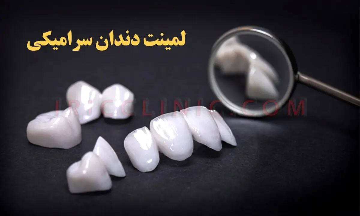 قیمت لمینت سرامیکی