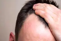 درمان ریزش مو را با انجام این ورزش‌های آسان