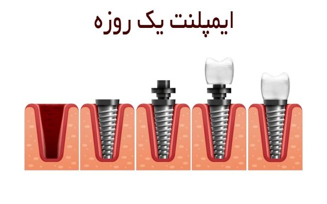 معایب ایمپلنت یک روزه