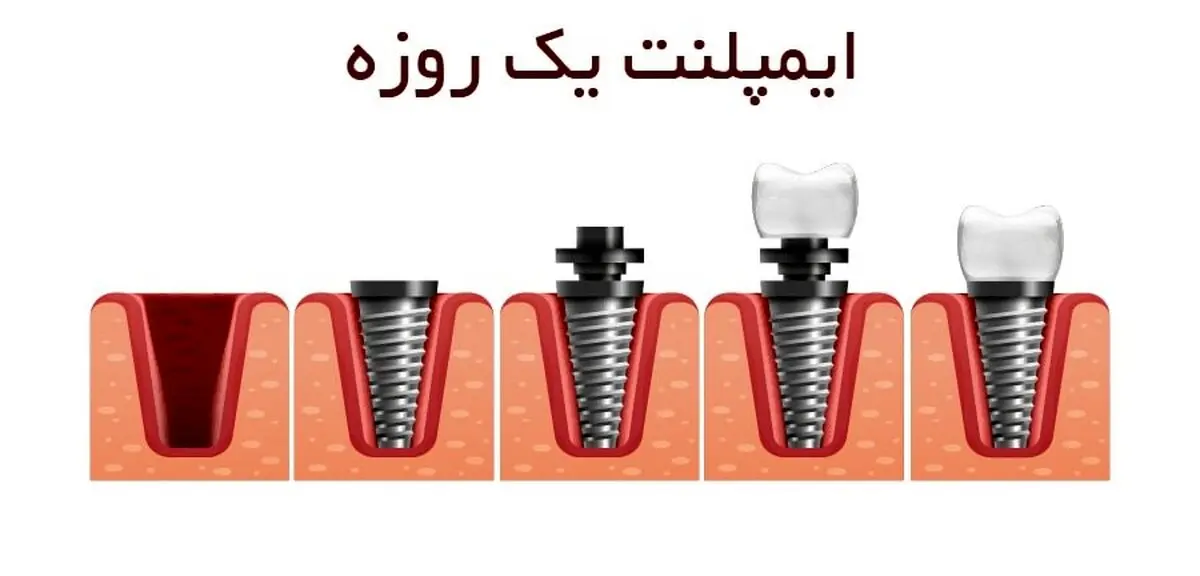 معایب ایمپلنت یک روزه