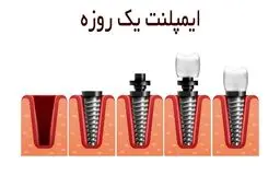 معایب ایمپلنت یک روزه