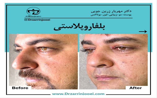 رفع پف چشم و افتادگی پلک با روش بلفاروپلاستی