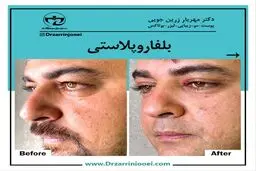 رفع پف چشم و افتادگی پلک با روش بلفاروپلاستی