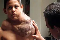 سنگینی‌تومور بر‌شانه‌کودک‌مکزیکی/عکس