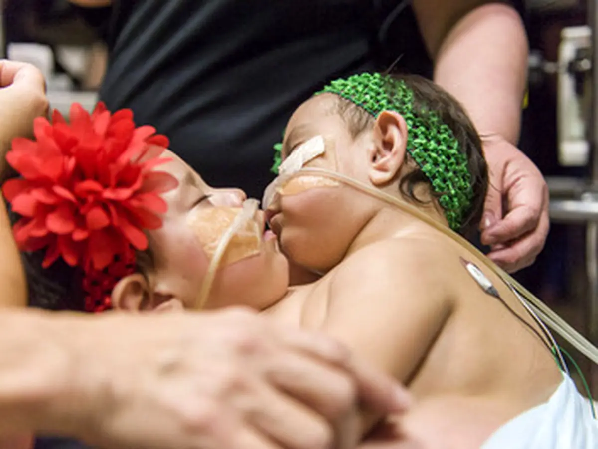 پیچیده‌ترین عمل جداسازی دوقلوها/تصاویر