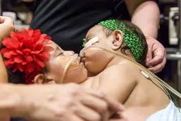 پیچیده‌ترین عمل جداسازی دوقلوها/تصاویر