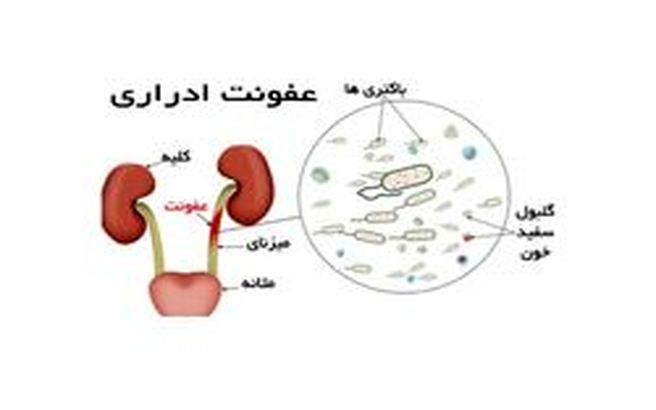 علائم "عفونت ادراری" چیست؟ + راهکارهای پیشگیری و درمان