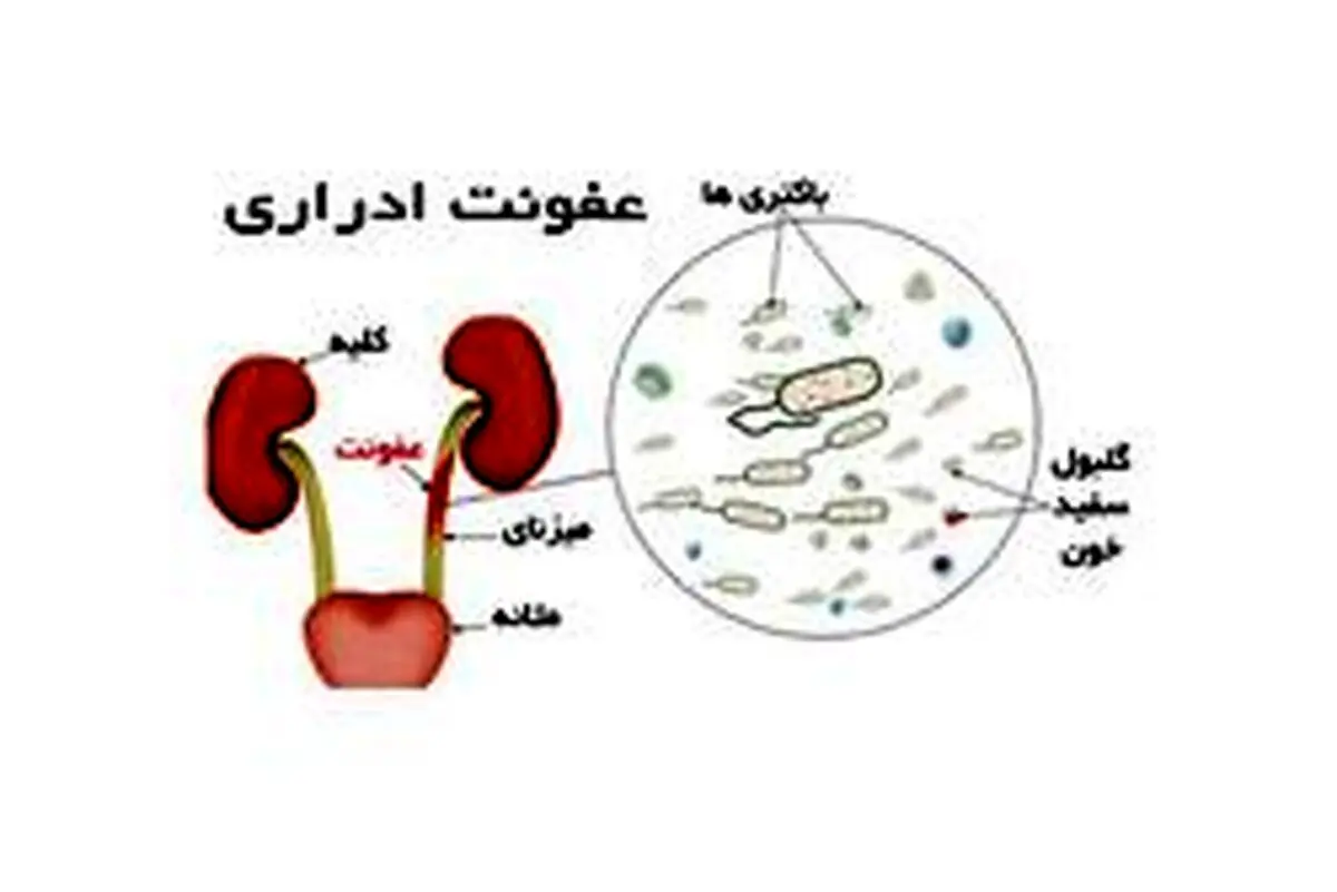 علائم "عفونت ادراری" چیست؟ + راهکارهای پیشگیری و درمان