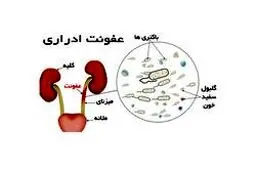 علائم "عفونت ادراری" چیست؟ + راهکارهای پیشگیری و درمان