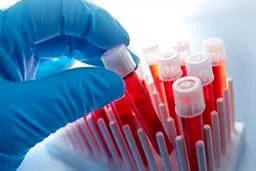 آزمایش ادرار چه بیماری‌هایی را مشخص می‌کند؟