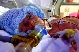 نجات کودکی که تنها 5 درصد شانس زنده ماندن داشت + عکس