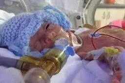 نجات کودکی که تنها 5 درصد شانس زنده ماندن داشت + عکس