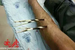 حمله جوجه تیغی به کشاورز خرم آبادی+عکس