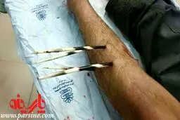 حمله جوجه تیغی به کشاورز خرم آبادی+عکس