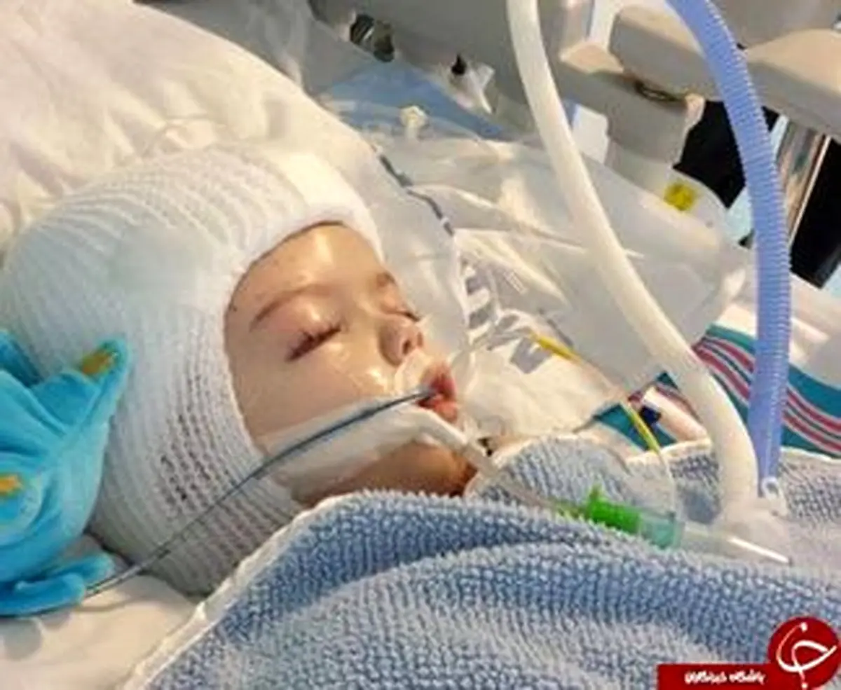 جداسازی دوقلوهای به هم چسبیده!/تصاویر