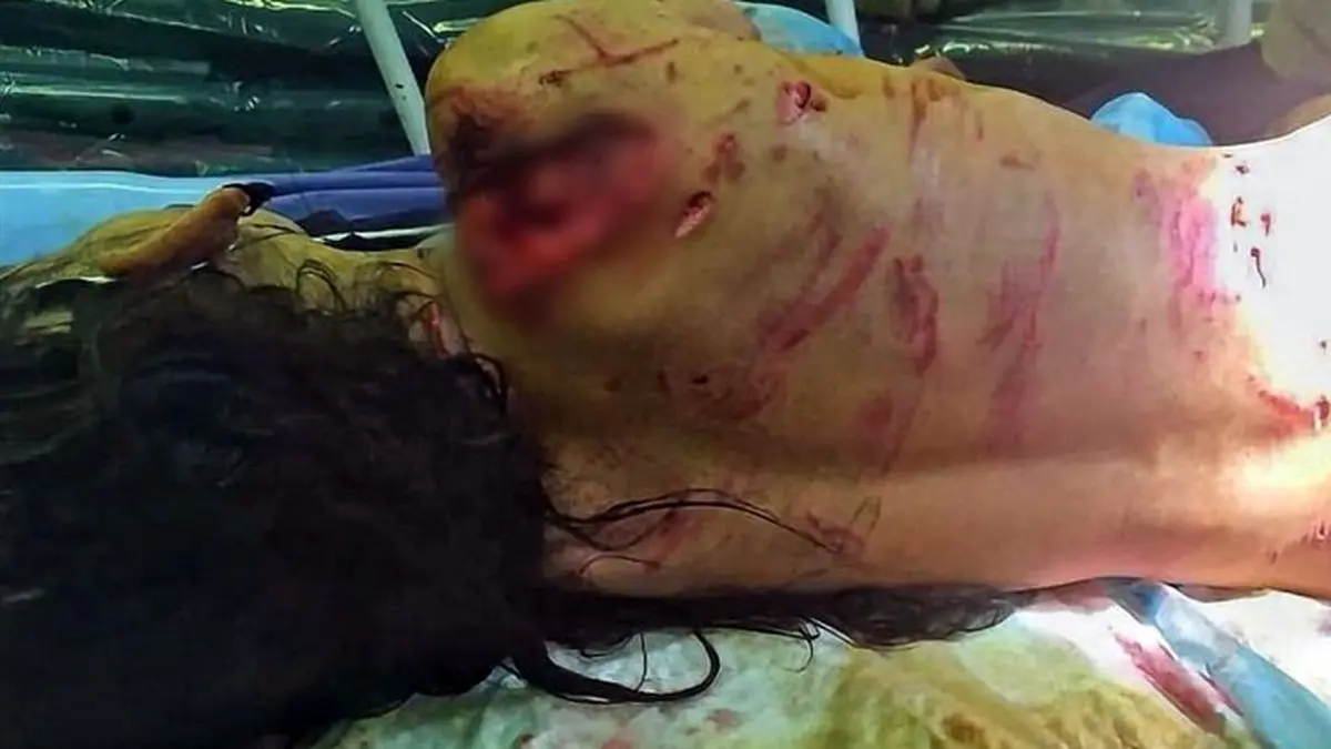 عکس وحشتناک از تکه پاره شدن دختربچه توسط سگ ولگرد / در شهرری رخ داد