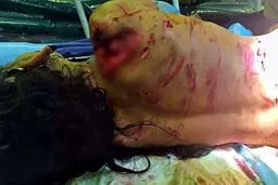 عکس وحشتناک از تکه پاره شدن دختربچه توسط سگ ولگرد / در شهرری رخ داد