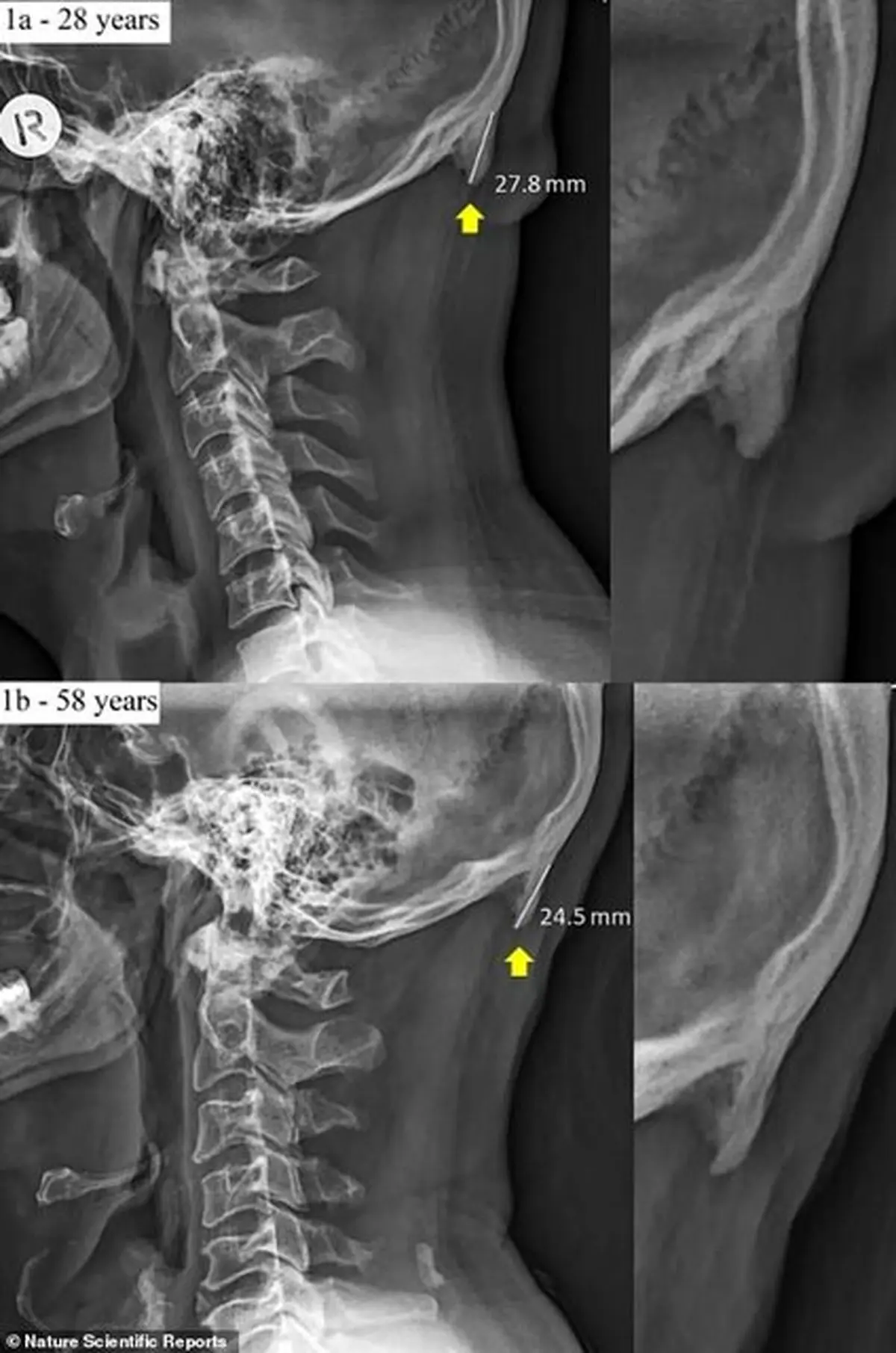 تغییر شکل جمجمه به دلیل کار زیاد با موبایل + عکس