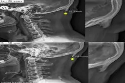تغییر شکل جمجمه به دلیل کار زیاد با موبایل + عکس