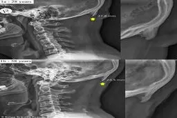 تغییر شکل جمجمه به دلیل کار زیاد با موبایل + عکس