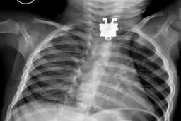 عکس/ شی عجیب‌ در گلوی نوزادعربستانی