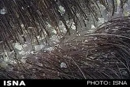 چند توصیه برای درمان شوره‌سر