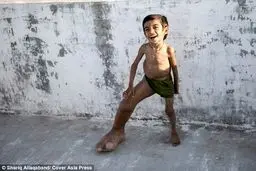 بیماری عجیب پسر چهار ساله هندی/تصاویر