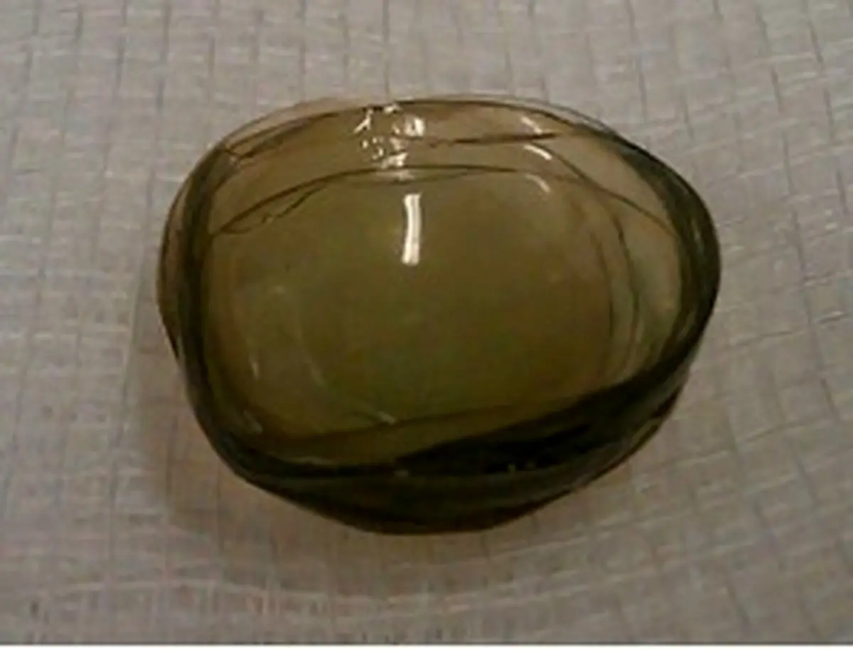 انباشته شدن ۲۷ لنز طبی در چشم زن ۶۷ ساله