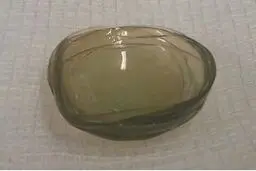 انباشته شدن ۲۷ لنز طبی در چشم زن ۶۷ ساله