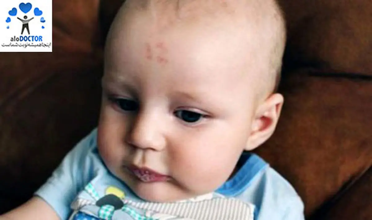 تولد نوزادی که عدد ۱۲ روی پیشانی‌اش درج شده + عکس