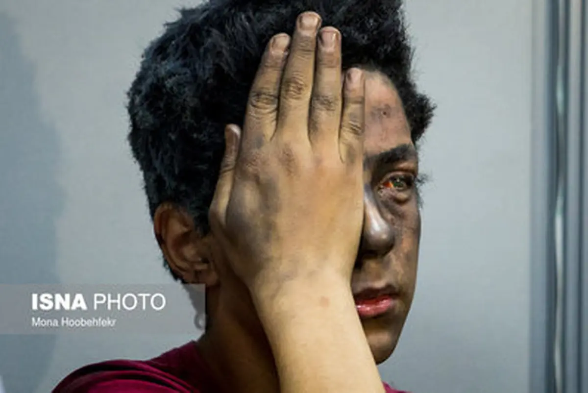 تصاویری دردناک از مصدومان چهارشنبه سوری !